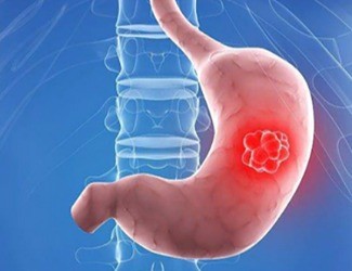 你知道嗎？從慢性胃炎到胃癌，只有四步！